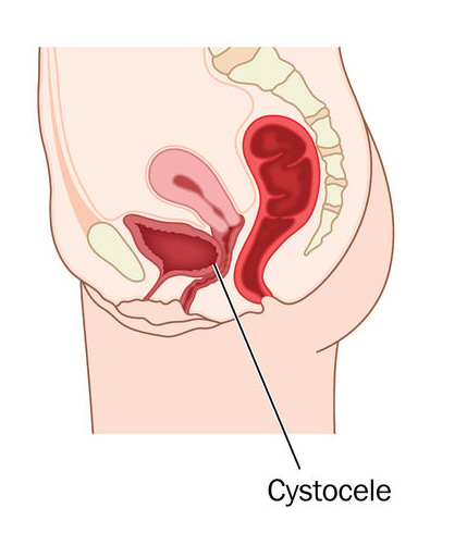 A cystocele is also known as a bladder - Stock Illustration [103449203]  - PIXTA