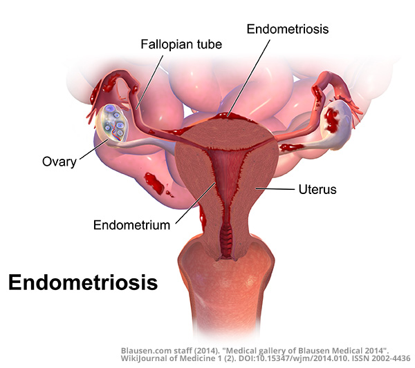 Blausen 0349 Endometriosis